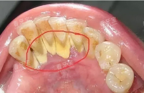 牙结石实拍图片 牙结石实拍图片