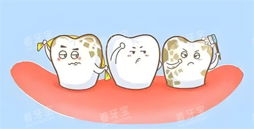 牙结石 牙结石