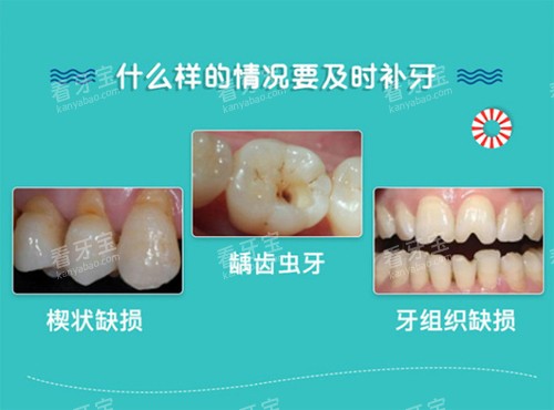 补牙适应症 补牙适应症