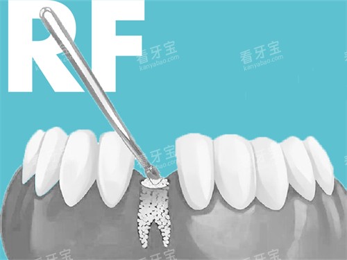 种植牙植骨漫画图 种植牙植骨漫画图