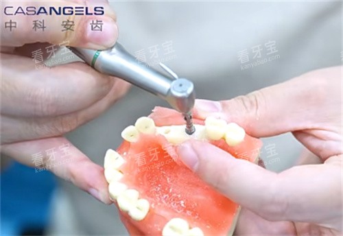 中科安齿种植牙钻孔 中科安齿种植牙钻孔