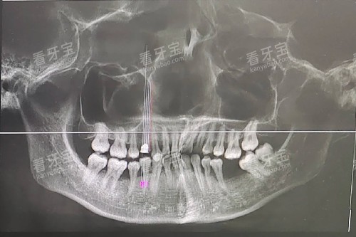牙周炎 牙龈萎缩 缺牙 牙周炎 牙龈萎缩 缺牙