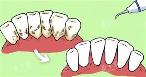 牙周炎治疗 牙周炎治疗