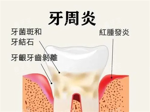 牙周炎漫画示意图 牙周炎漫画示意图