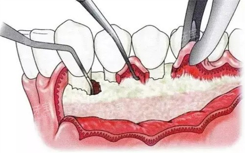 牙周炎翻瓣手术全过程 牙周炎翻瓣手术全过程