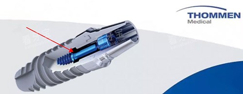 瑞士ITI种植体 瑞士ITI种植体