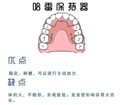 牙齿矫正哈雷保持器 牙齿矫正哈雷保持器