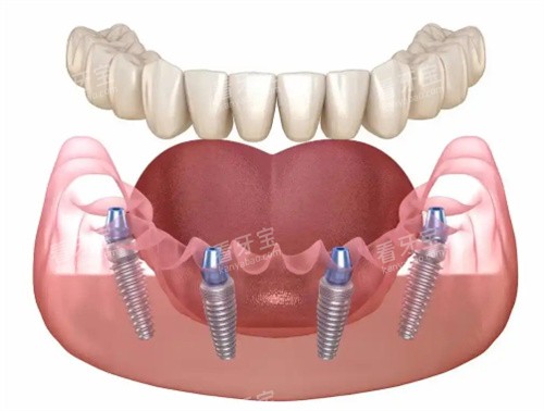 种植牙展示卡通图 种植牙展示卡通图