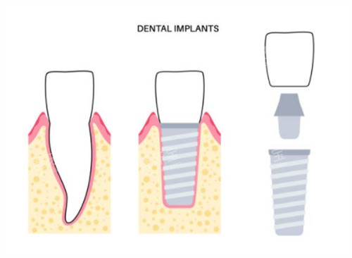种植牙前后对比图片 种植牙前后对比图片