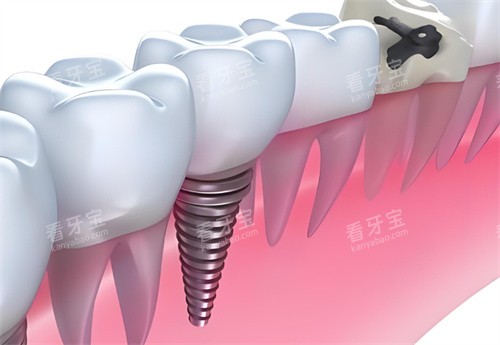 种植牙卡通展示 种植牙卡通展示