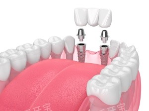 牙齿种植结构示意图 牙齿种植结构示意图
