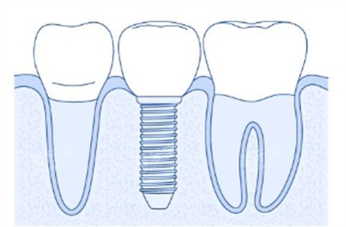 简单种植牙背景图 简单种植牙背景图
