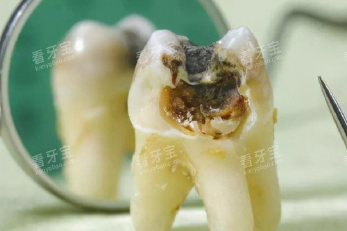 牙齿从根部开始烂图片 牙齿从根部开始烂图片
