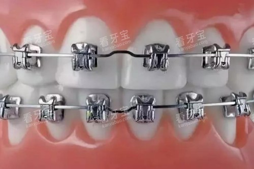 金属矫正卡通模型图 金属矫正卡通模型图