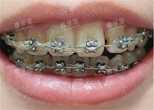 龅牙金属矫正图 龅牙金属矫正图