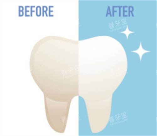 牙齿美白对比 牙齿美白对比