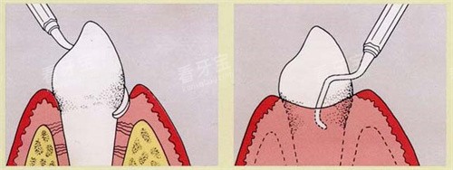 龈下刮治图 龈下刮治图