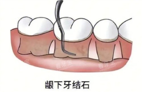 龈下刮治 龈下刮治