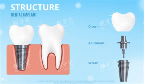 种植牙拆解示意图 种植牙拆解示意图