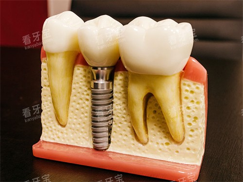 种植牙模型图 种植牙模型图