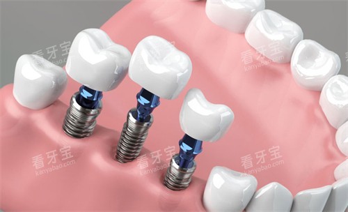 种植牙在口腔内的样子 种植牙在口腔内的样子