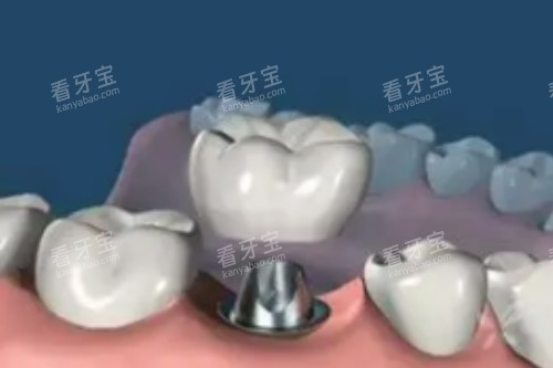 单颗种植牙卡通图片展示 单颗种植牙卡通图片展示