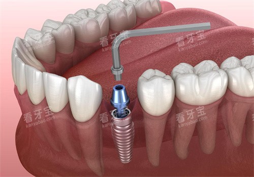 海口种植牙哪家医院好?诺贝尔、矫植美等5家口碑院上榜!兼顾“便宜又好”,选对医院不踩坑