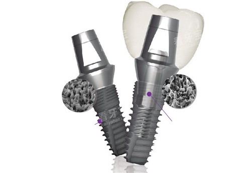 登腾种植牙 登腾种植牙