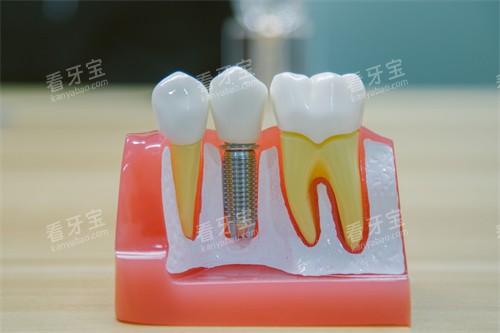 牙科种植牙模型 牙科种植牙模型