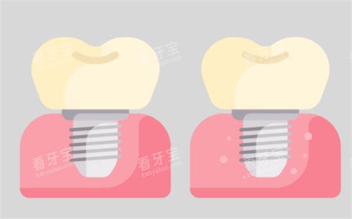 种植牙对比图 种植牙对比图