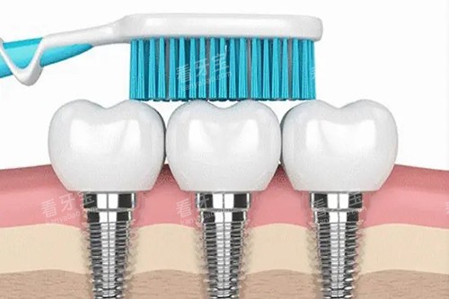 种植牙清洁卡通宣传图 种植牙清洁卡通宣传图