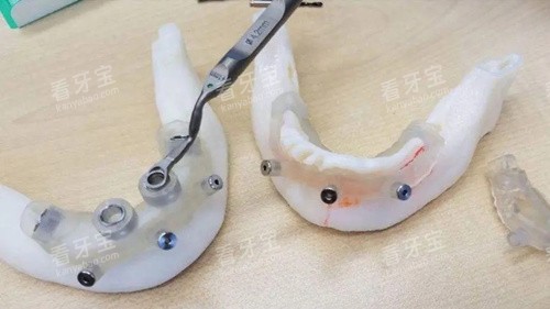 种植牙导板3D打印.webp 种植牙导板3D打印.webp