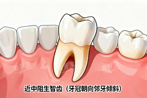 近中阻生智齿展示图 近中阻生智齿展示图