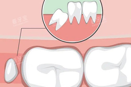 长智齿的初期示意图 长智齿的初期示意图