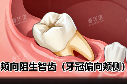 颊向阻生智齿展示图 颊向阻生智齿展示图