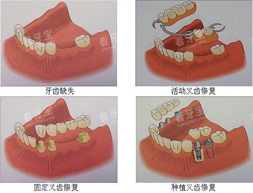 牙齿缺失修复多种方式 牙齿缺失修复多种方式