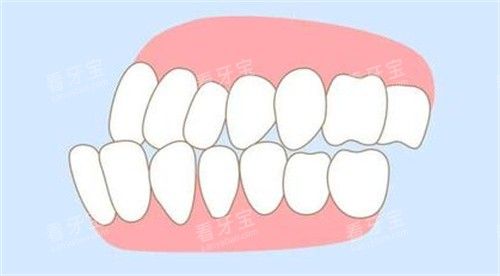 牙齿错颌畸形照片 牙齿错颌畸形照片