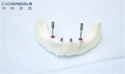 中科安齿种植牙 中科安齿种植牙