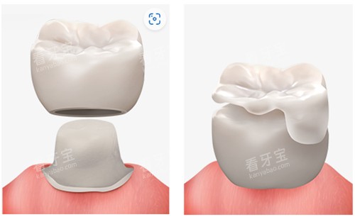 补牙图示 补牙图示