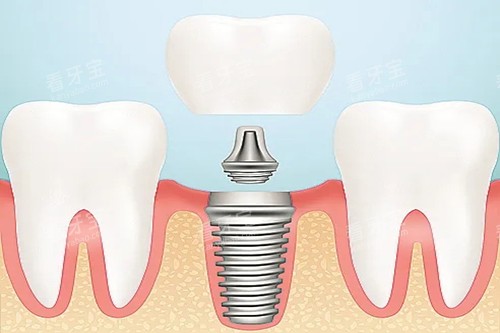 口腔种植牙卡通示意图 口腔种植牙卡通示意图
