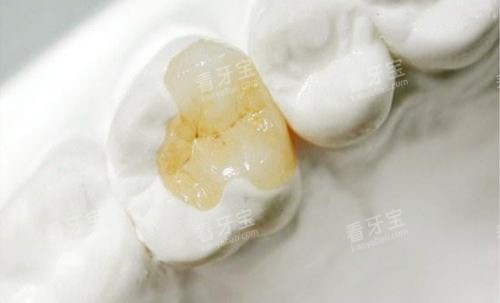 美国3m补牙 美国3m补牙