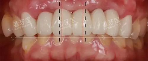 牙齿修复数据测量 牙齿修复数据测量