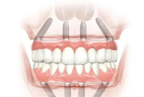 全口种植牙的示意图 全口种植牙的示意图