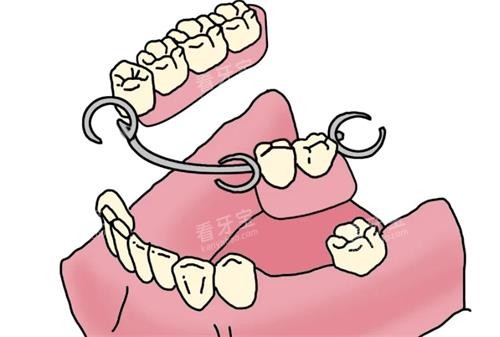 活动义齿动画图 活动义齿动画图