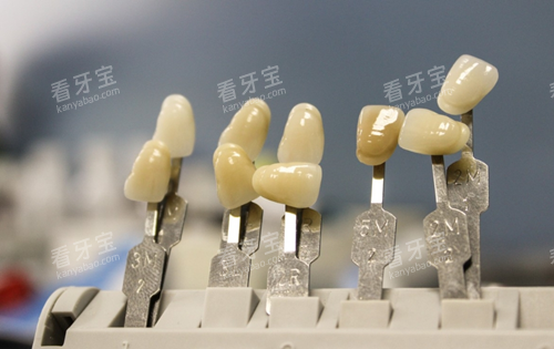 牙齿贴面 牙齿贴面