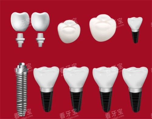 种植牙种植体牙冠 种植牙种植体牙冠