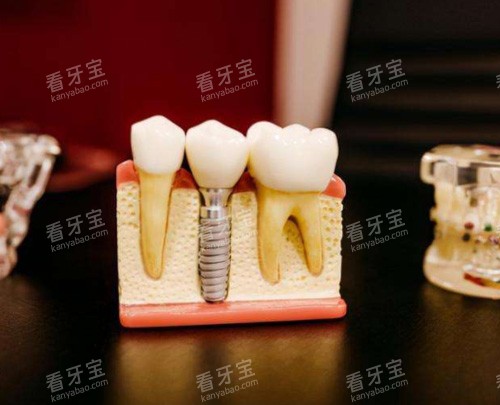 种植牙模具图 种植牙模具图