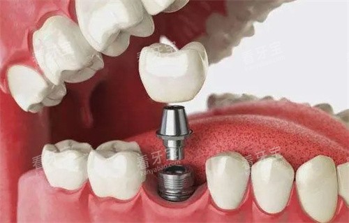 摩尔口腔医院新版价格表:种植牙3980元起、牙齿矫正9900元起、全瓷牙1500元起