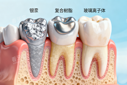 各类型补牙材料卡通图 各类型补牙材料卡通图