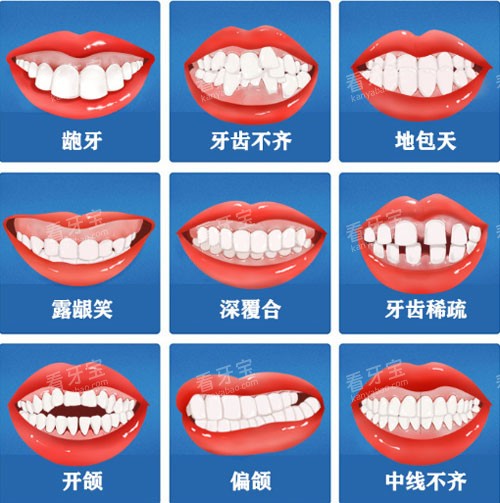 牙齿矫正适应症 牙齿矫正适应症